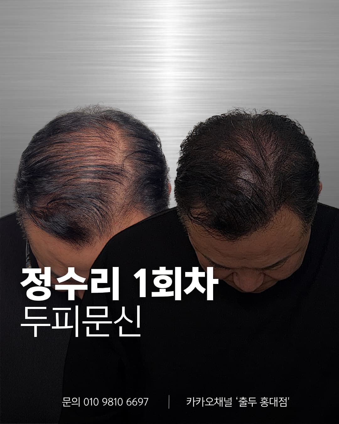 두피문신 M자 탈모 커버 사례