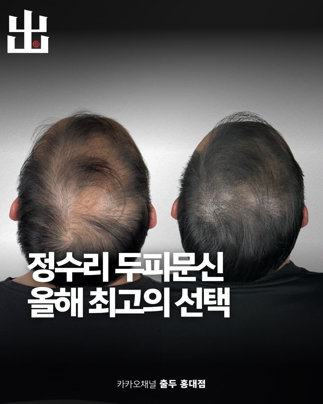 출두 정문찬 원장 SMP 시술 결과