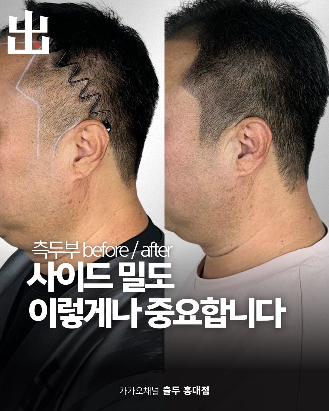 SMP 헤어라인 복원 시술 결과