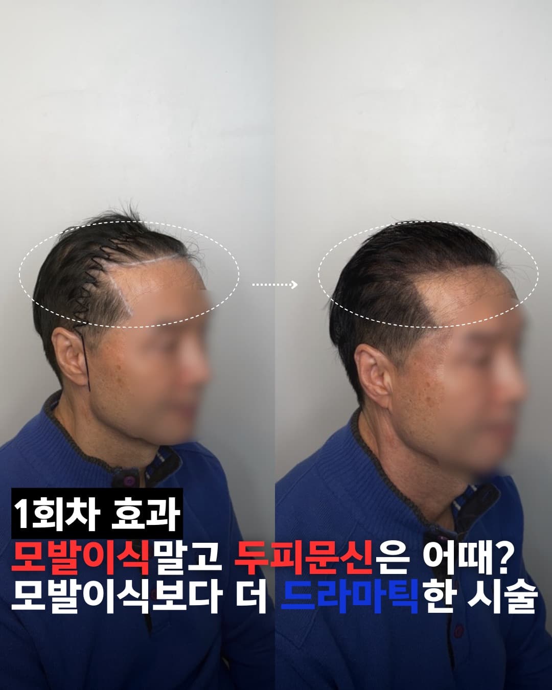 남성 정수리 두피문신 전후 비교