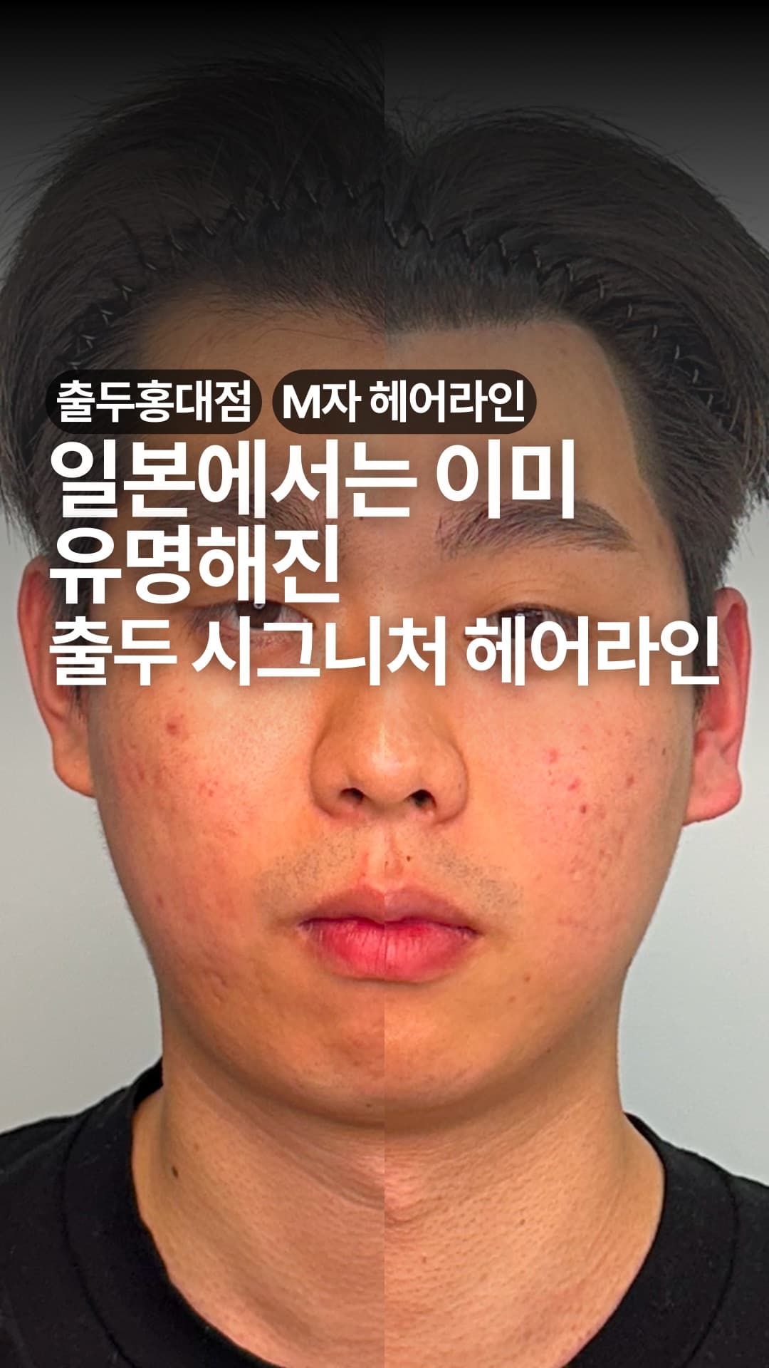 두피문신 헤어라인 디자인 시술