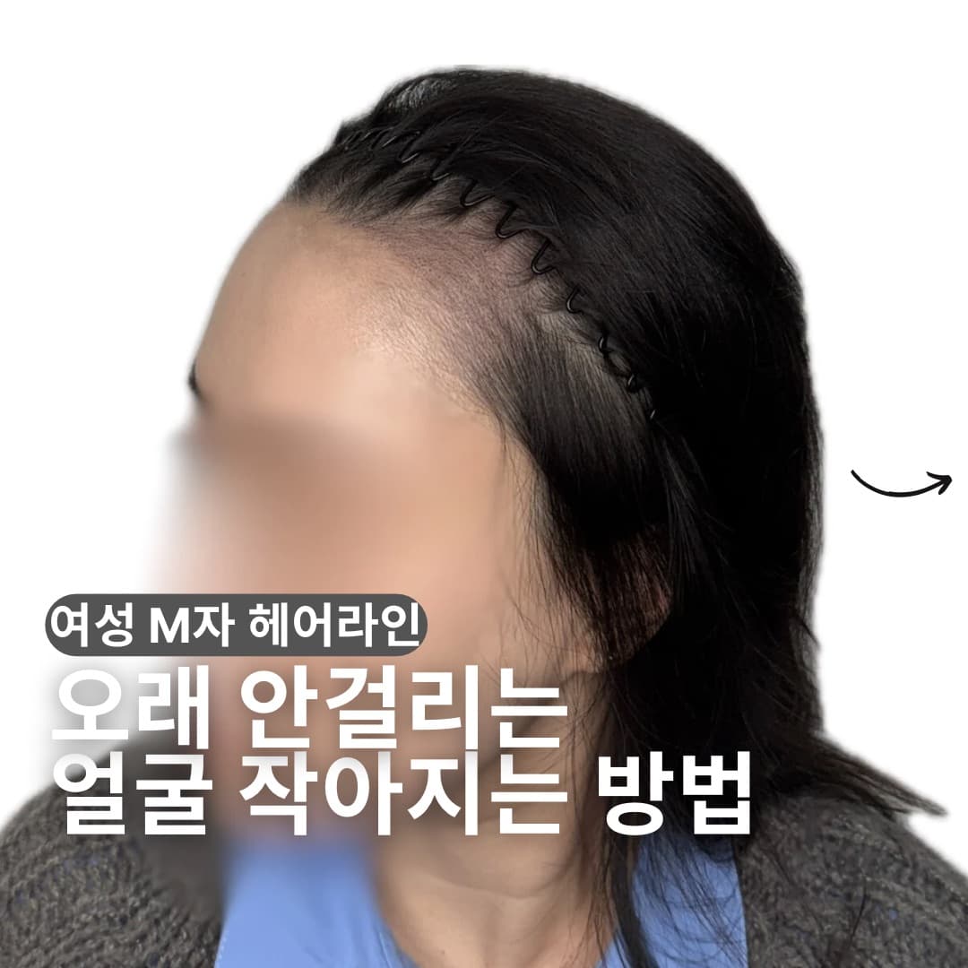 M자 탈모 두피문신 자연스러운 결과