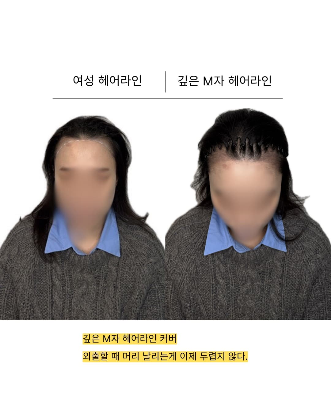 두피문신 전문가 정문찬 시술 결과
