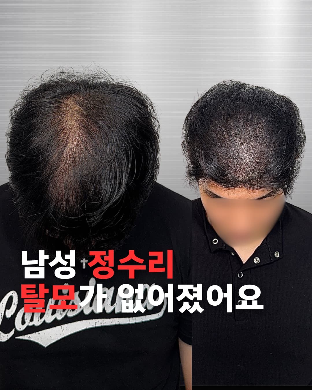 SMP 시술 전후 변화 사례