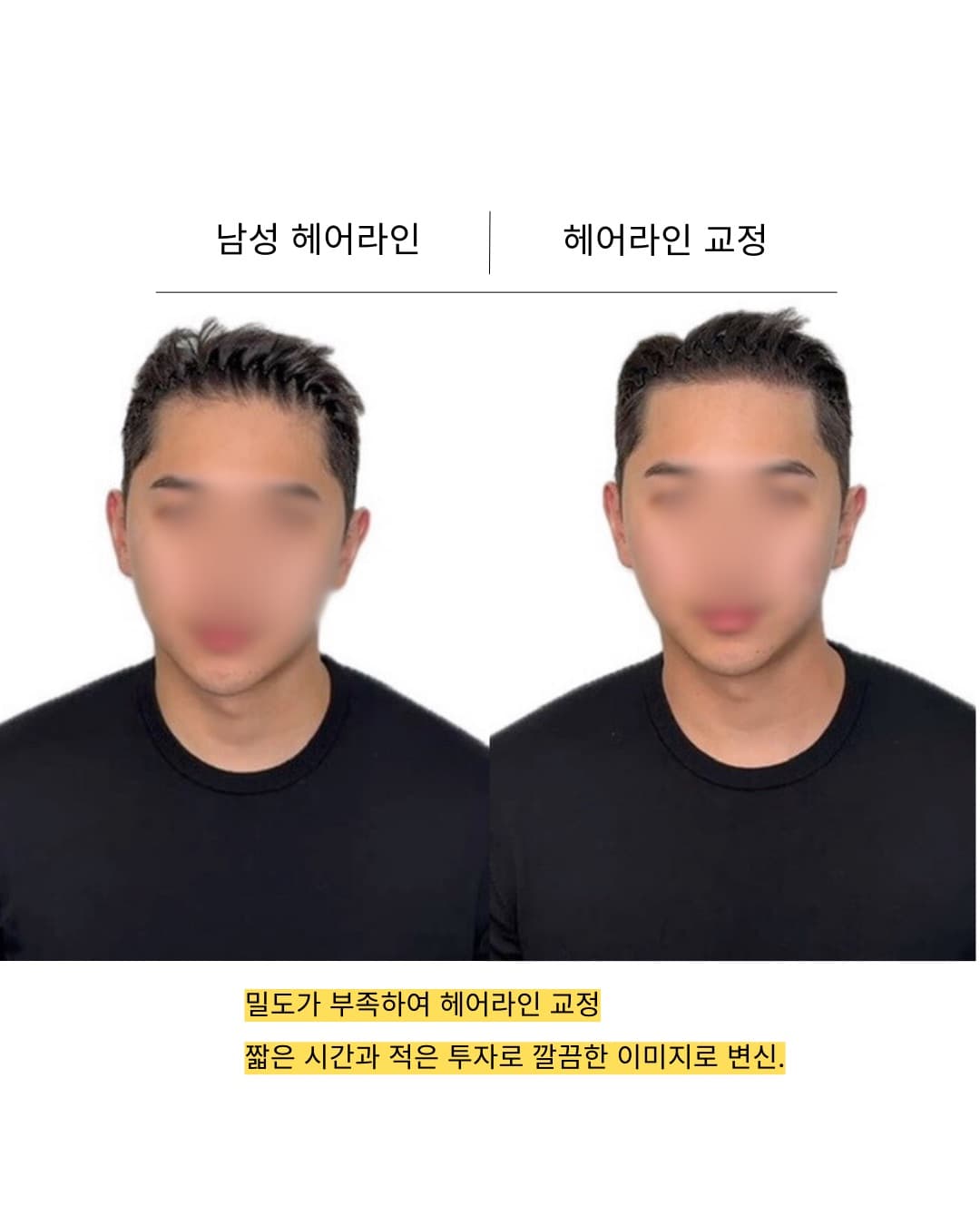 남성 SMP 헤어라인 시술 전후