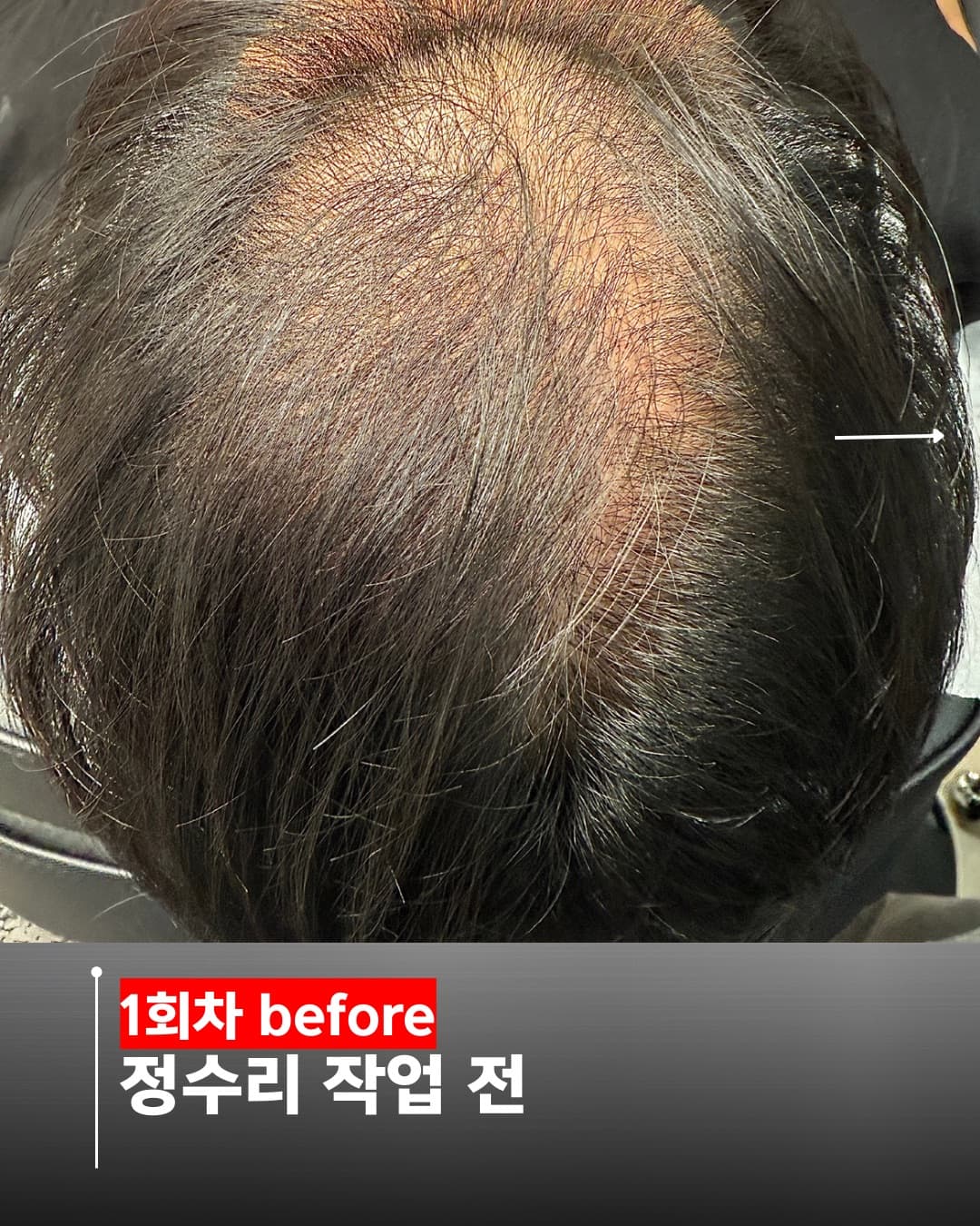 출두 두피문신 M자 교정 사례