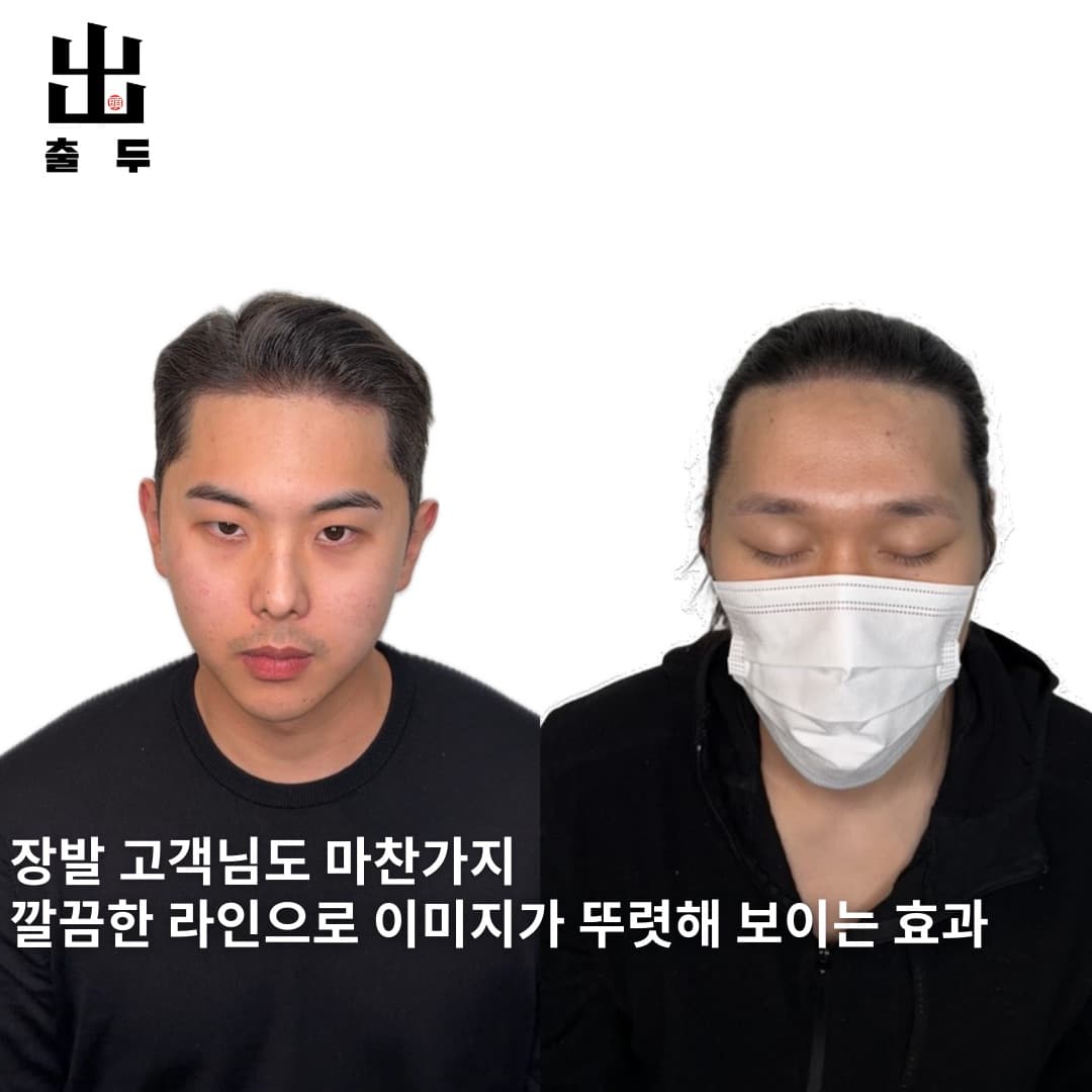 M자 이마 두피문신 시술 사례