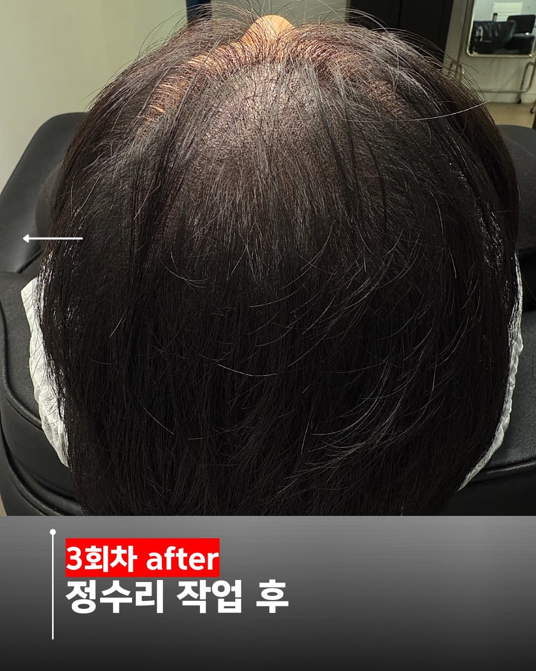 두피문신 정수리 시술 자연스러운 표현