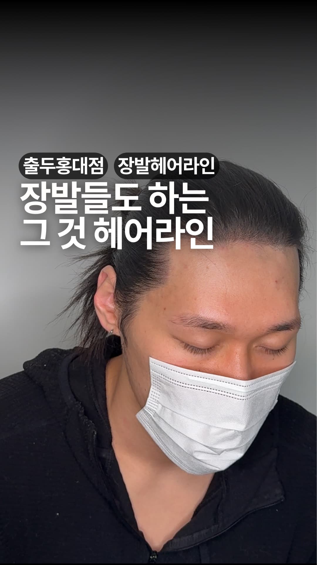 SMP 탈모 커버 시술 전후 비교