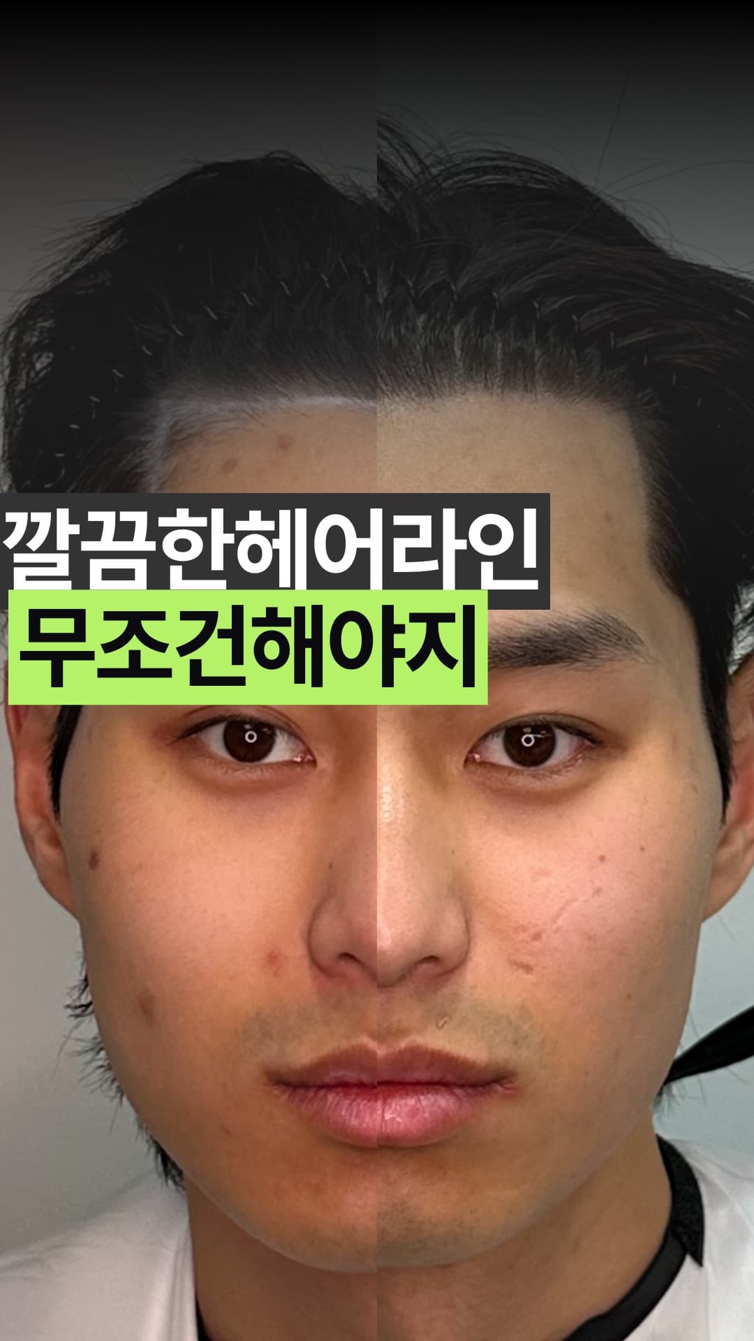 홍대 SMP 전문 시술 결과 사진