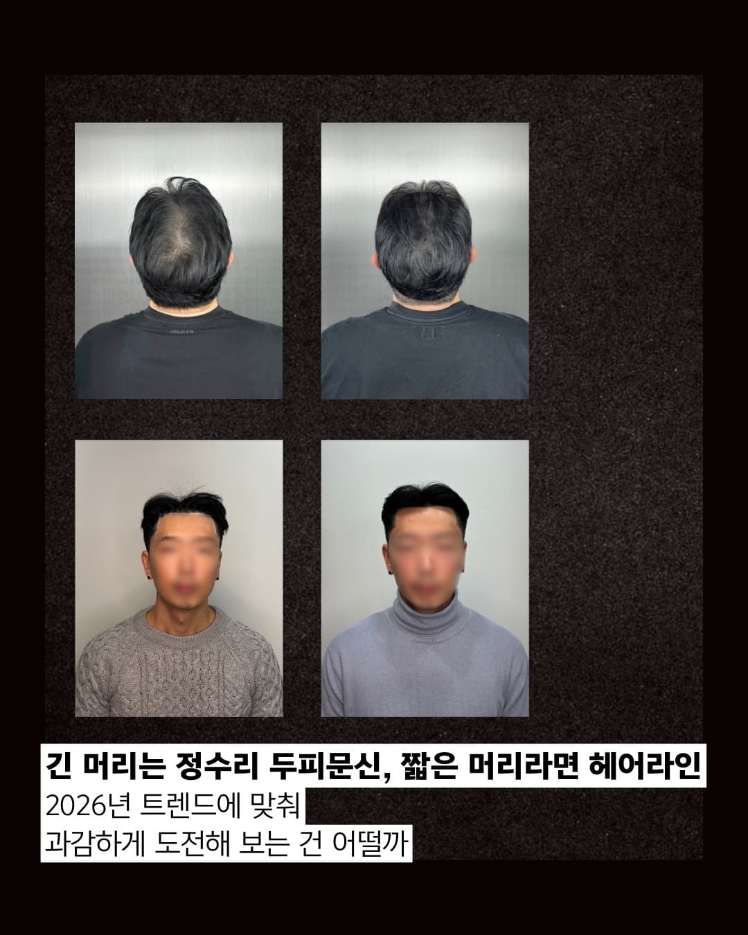 두피문신 헤어라인 복원 전후