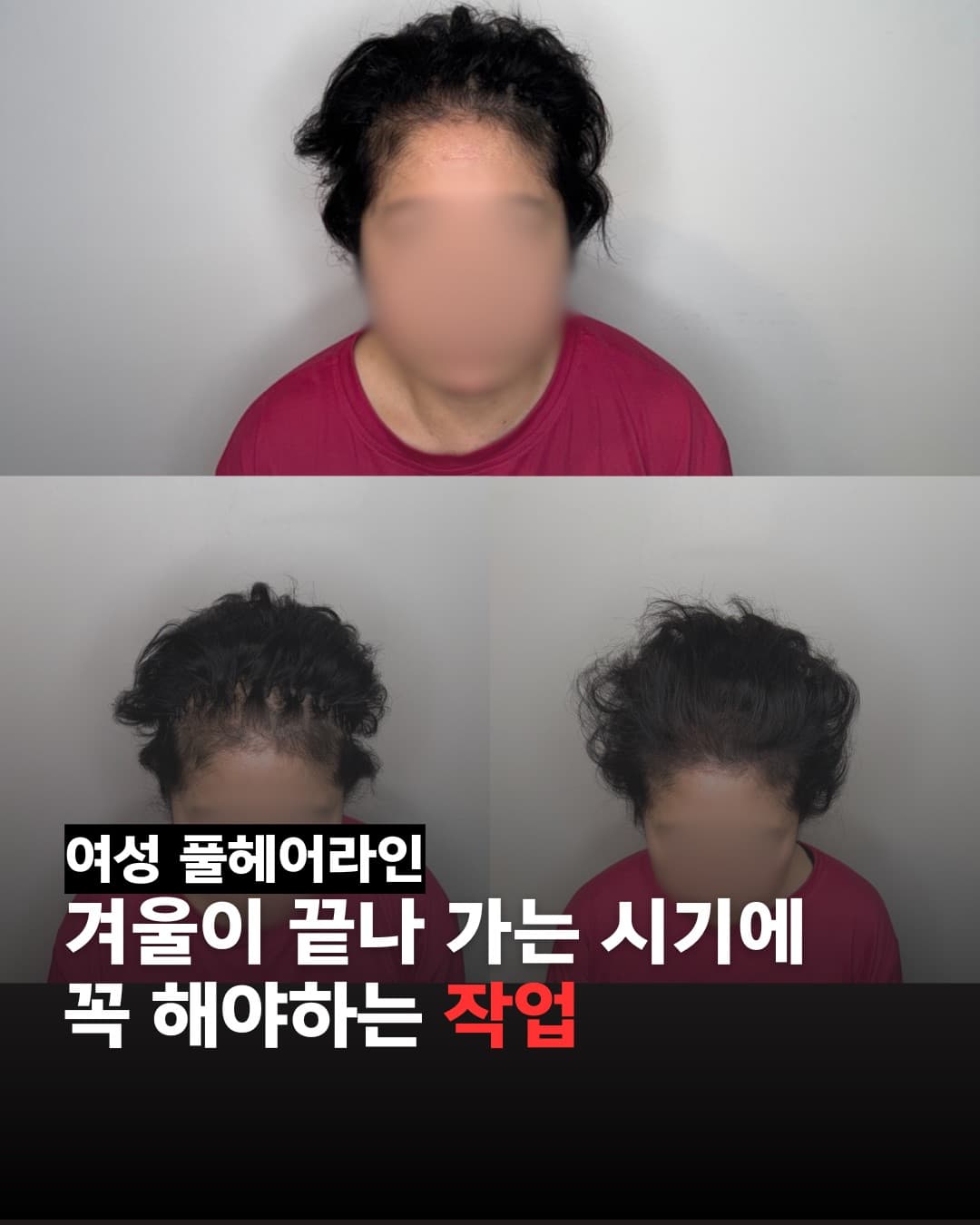 탈모 두피문신 커버 시술 후기