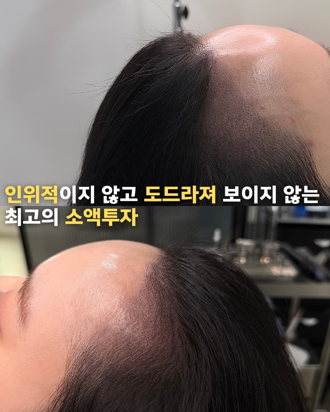 SMP 정수리 숱채움 시술 결과
