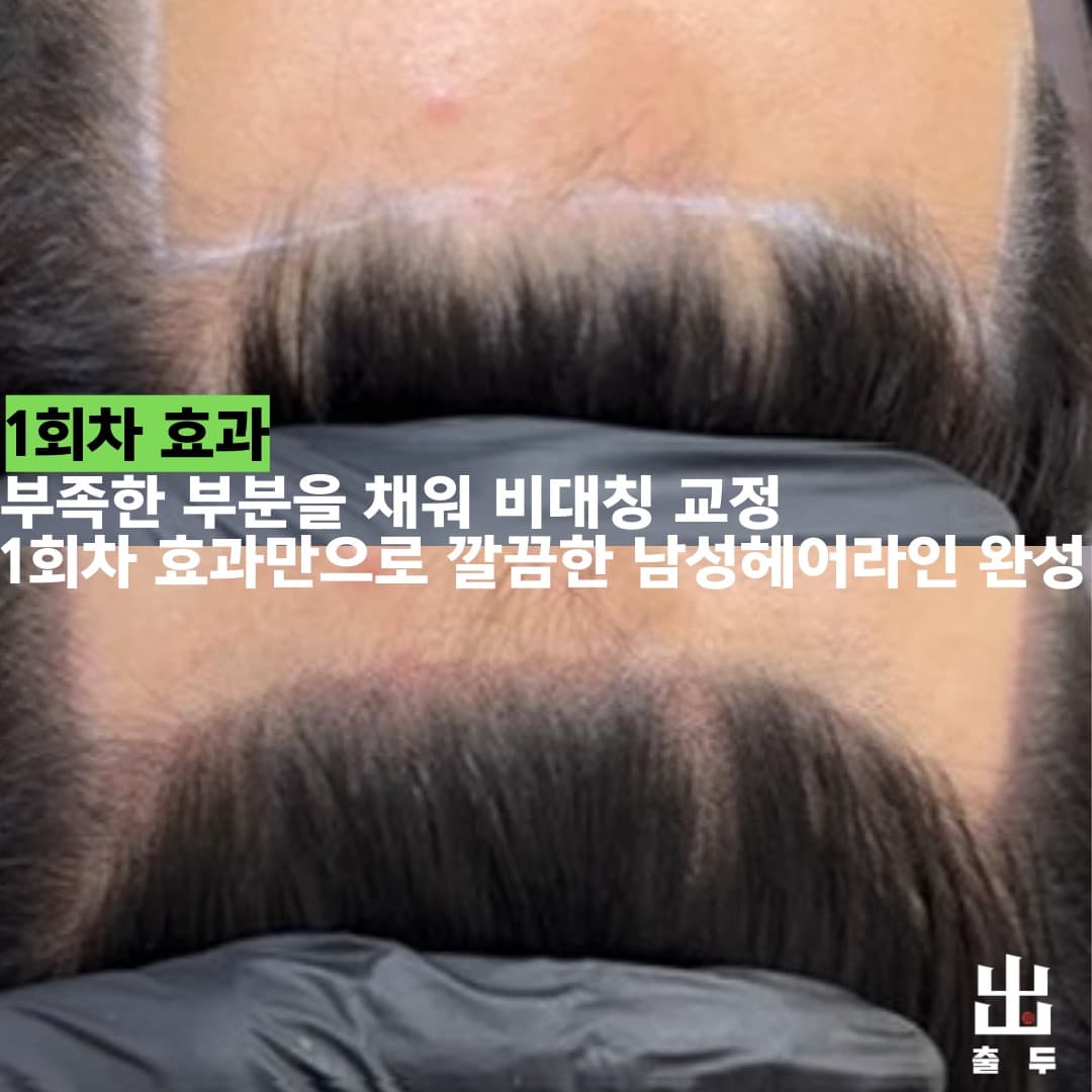 홍대 SMP 전문 출두 시술 사례