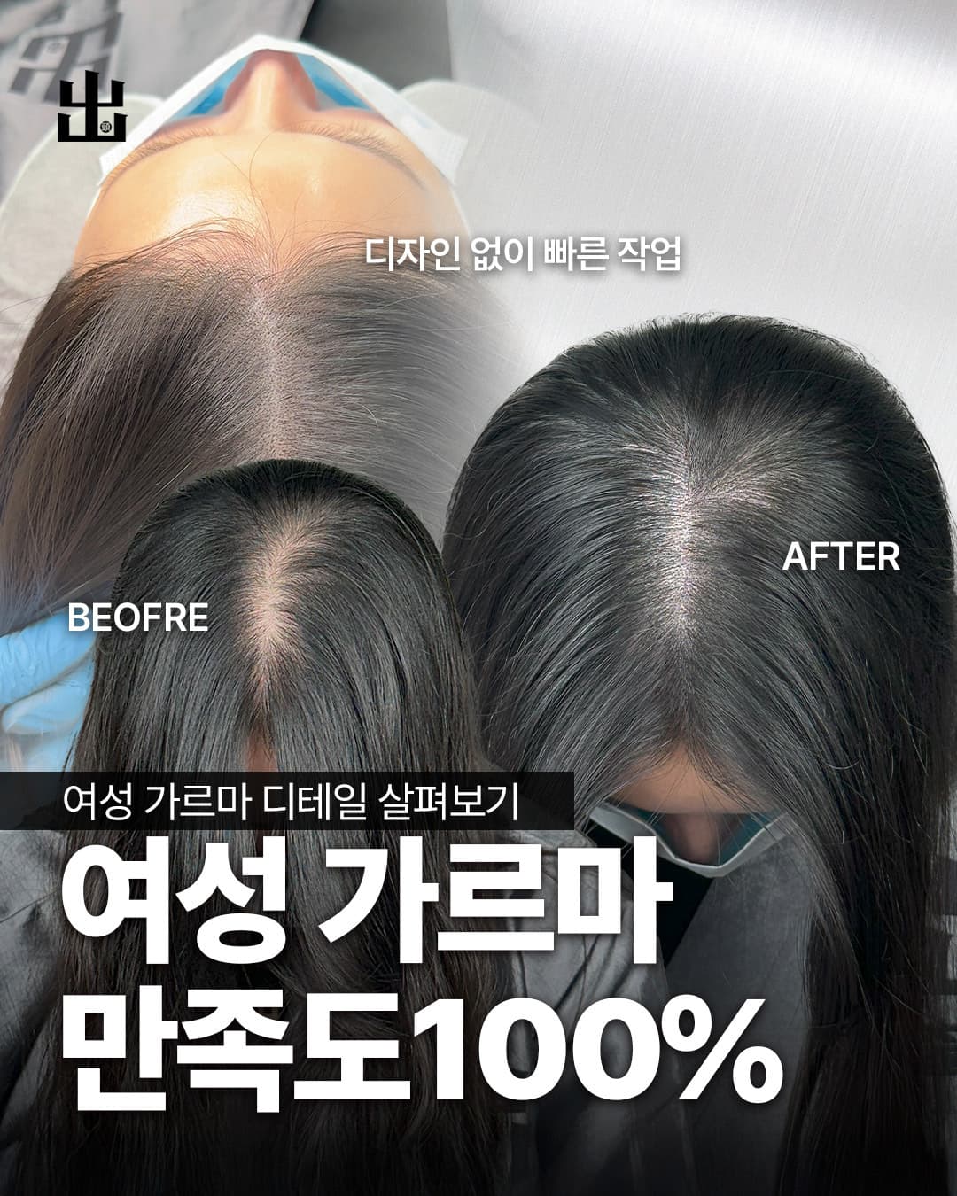 여성 가르마 두피문신 숱채움 시술
