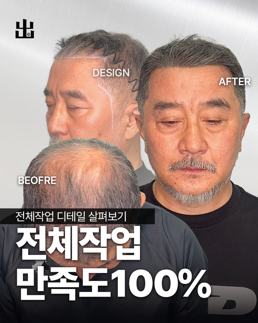 SMP 전체작업 탈모 커버 시술 사례