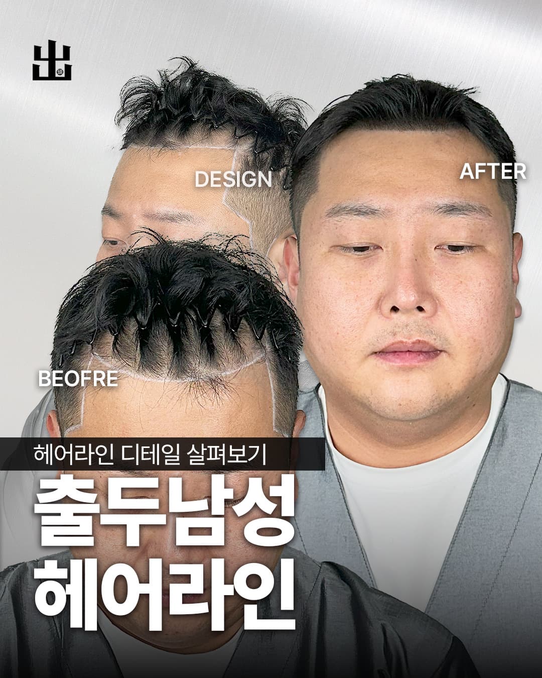 남성 M자 헤어라인 두피문신 교정